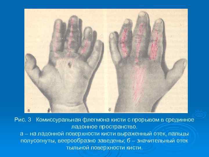 Рис. 3 Комиссуральная флегмона кисти с прорывом в срединное     ладонное