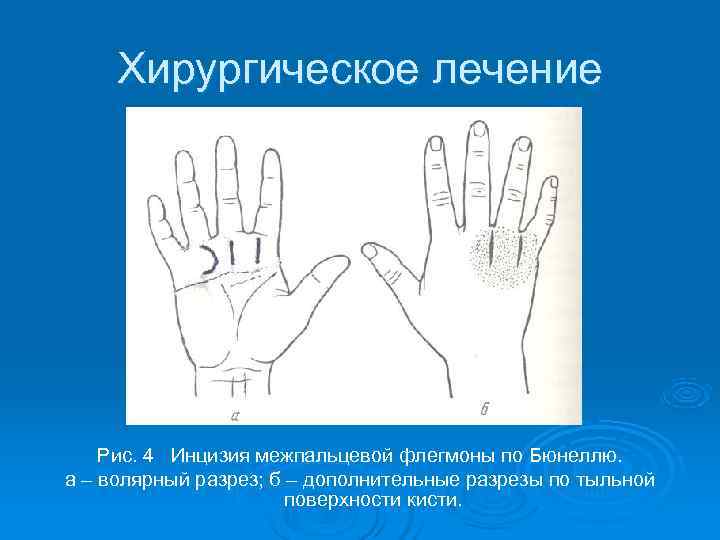  Хирургическое лечение   Рис. 4 Инцизия межпальцевой флегмоны по Бюнеллю. а –