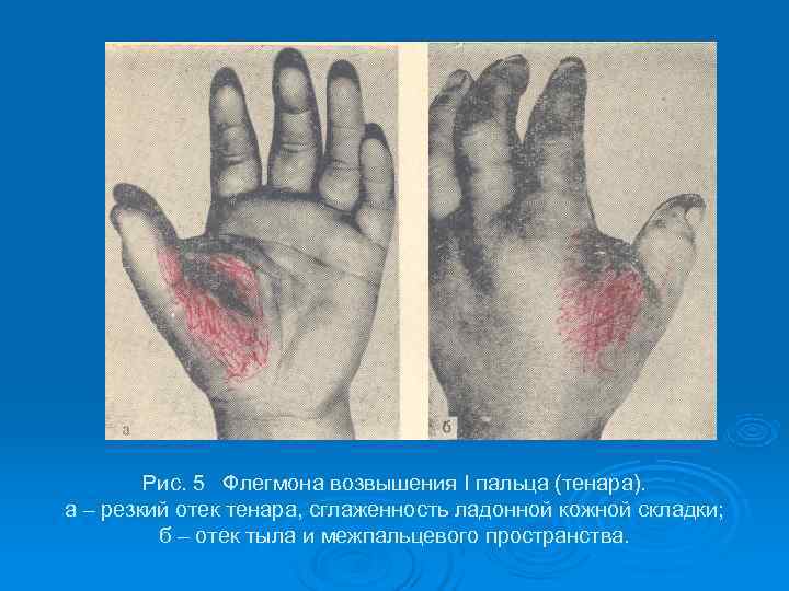   Рис. 5 Флегмона возвышения I пальца (тенара). а – резкий отек тенара,