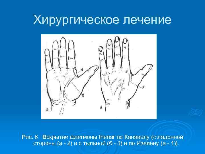   Хирургическое лечение Рис. 6 Вскрытие флегмоны thenar по Канавелу (с ладонной стороны