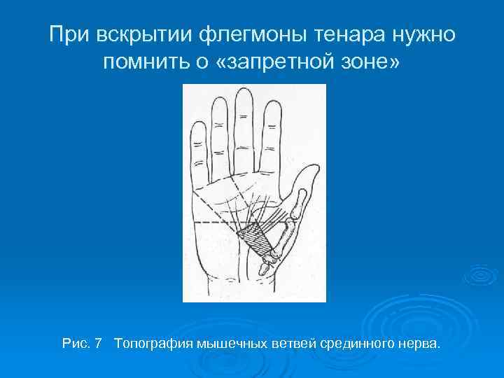 При вскрытии флегмоны тенара нужно помнить о «запретной зоне»  Рис. 7 Топография мышечных