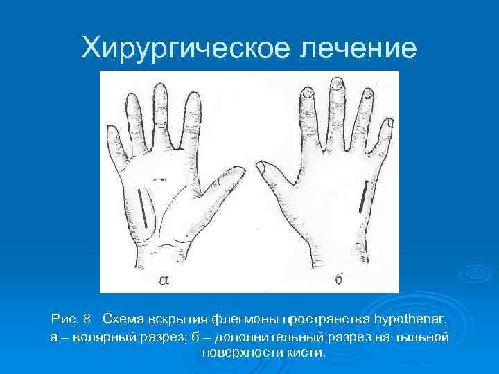   Хирургическое лечение Рис. 8 Схема вскрытия флегмоны пространства hypothenar. а – волярный