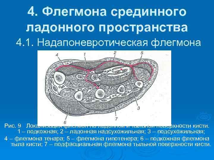   4. Флегмона срединного  ладонного пространства  4. 1. Надапоневротическая флегмона Рис.