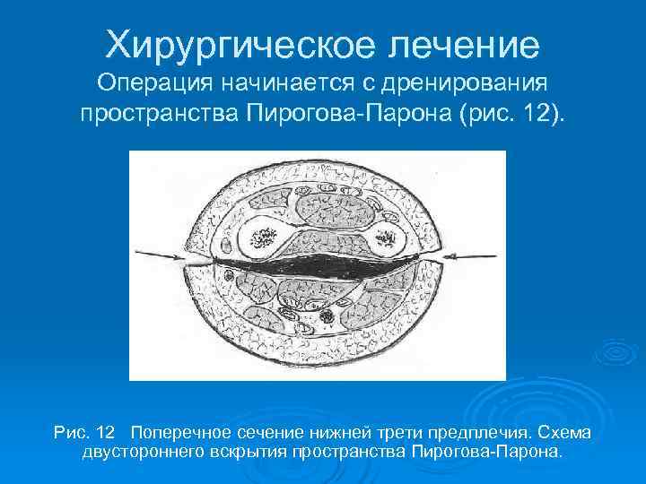  Хирургическое лечение  Операция начинается с дренирования  пространства Пирогова-Парона (рис. 12). Рис.