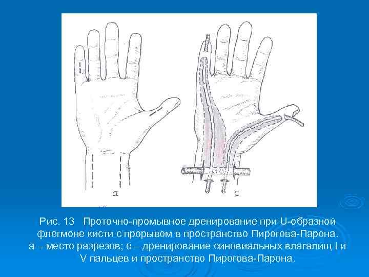  Рис. 13 Проточно-промывное дренирование при U-образной  флегмоне кисти с прорывом в пространство