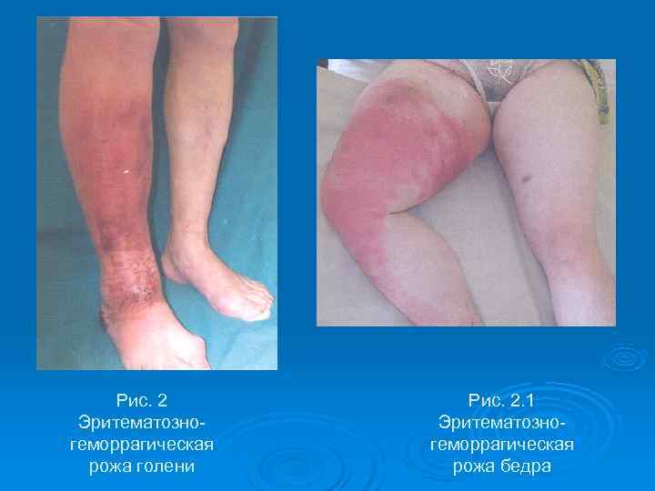  Рис. 2. 1 Эритематозно- геморрагическая  рожа голени  рожа бедра 