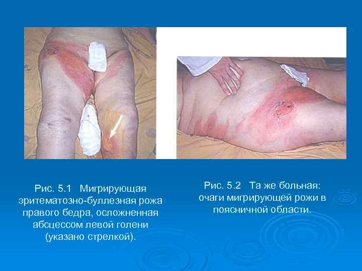   Рис. 5. 1 Мигрирующая  Рис. 5. 2 Та же больная: эритематозно-буллезная