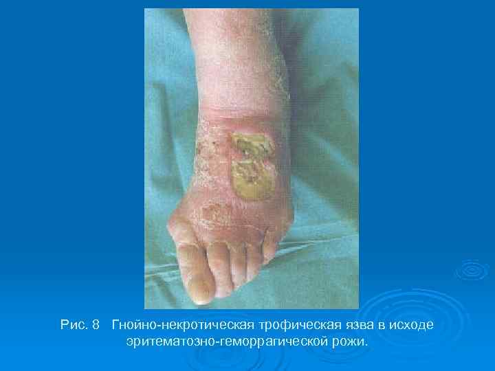 Рис. 8 Гнойно-некротическая трофическая язва в исходе   эритематозно-геморрагической рожи. 
