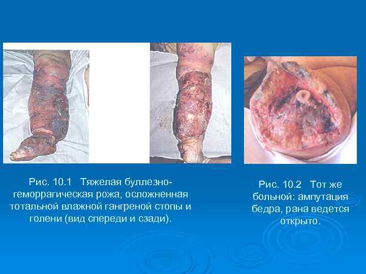   Рис. 10. 1 Тяжелая буллезно-  Рис. 10. 2 Тот же геморрагическая