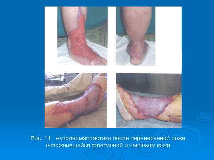 Рис. 11 Аутодермапластика после перенесенной рожи,  осложнившейся флегмоной и некрозом кожи. 