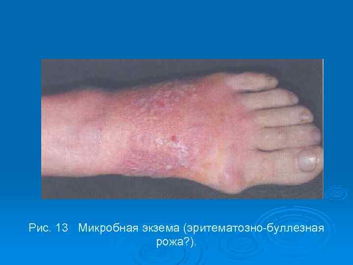 Рис. 13 Микробная экзема (эритематозно-буллезная     рожа? ). 
