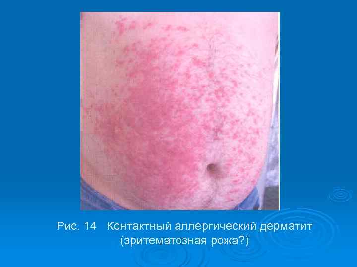 Рис. 14 Контактный аллергический дерматит  (эритематозная рожа? ) 