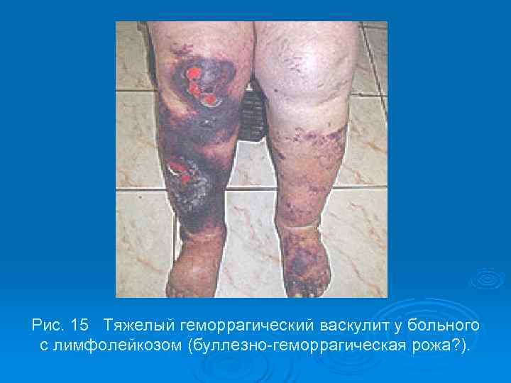 Рис. 15 Тяжелый геморрагический васкулит у больного с лимфолейкозом (буллезно-геморрагическая рожа? ). 