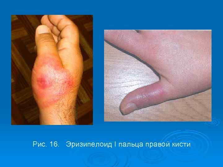 Рис. 16. Эризипелоид I пальца правой кисти 