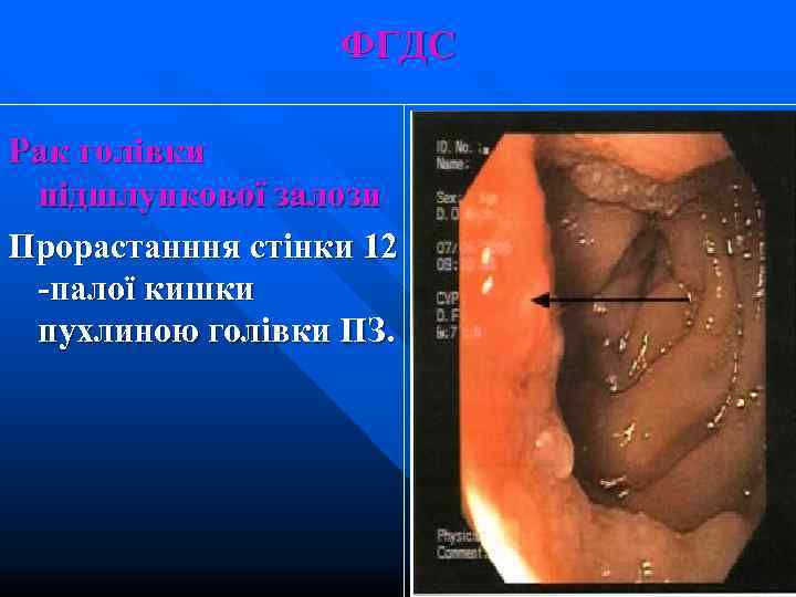    ФГДС Рак голівки підшлункової залози Прорастанння стінки 12 -палої кишки пухлиною