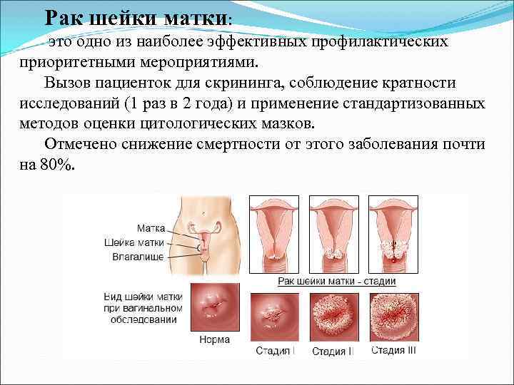   Рак шейки матки:  это одно из наиболее эффективных профилактических приоритетными мероприятиями.