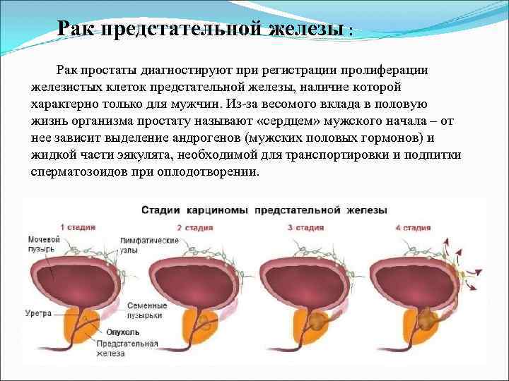   Рак предстательной железы :  Рак простаты диагностируют при регистрации пролиферации железистых