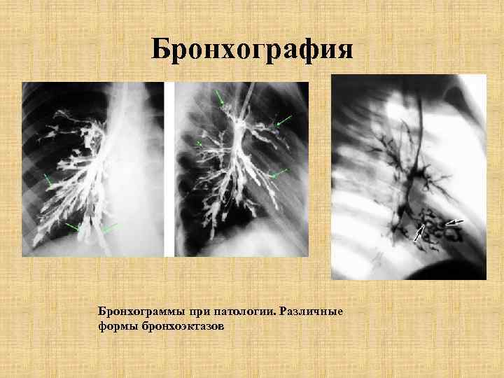   Бронхография Бронхограммы при патологии. Различные формы бронхоэктазов 