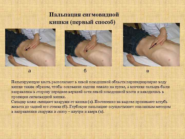 Пальпация сигмовидной кишки (первый способ) а б в Пальпирующую кисть располагают в левой повздошной