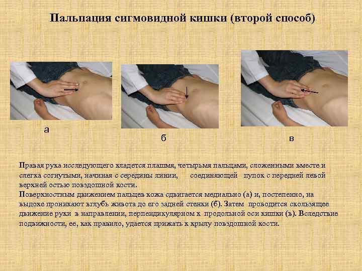 Пальпация сигмовидной кишки (второй способ) а б в Правая рука исследующего кладется плашмя, четырьмя