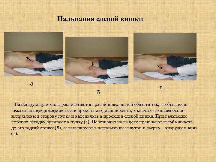 Пальпация слепой кишки а б в Пальпирующую кисть располагают в правой повздошной области так,