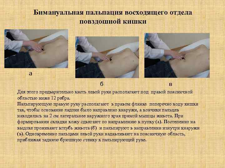 Бимануальная пальпация восходящего отдела повздошной кишки а б в Для этого предварительно кисть левой