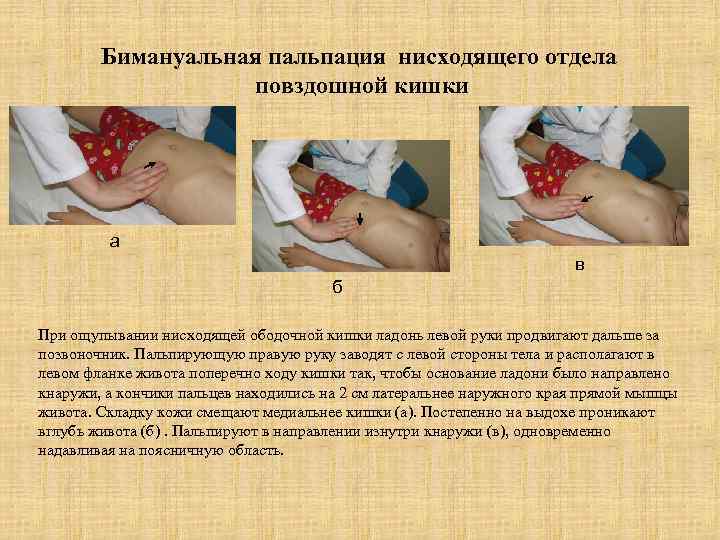 Бимануальная пальпация нисходящего отдела повздошной кишки а в б При ощупывании нисходящей ободочной кишки