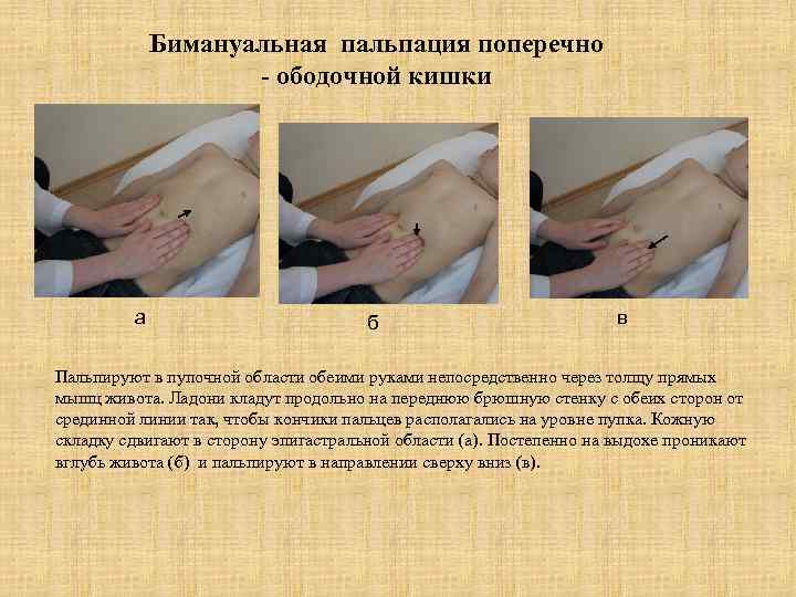 Бимануальная пальпация поперечно - ободочной кишки а б в Пальпируют в пупочной области обеими