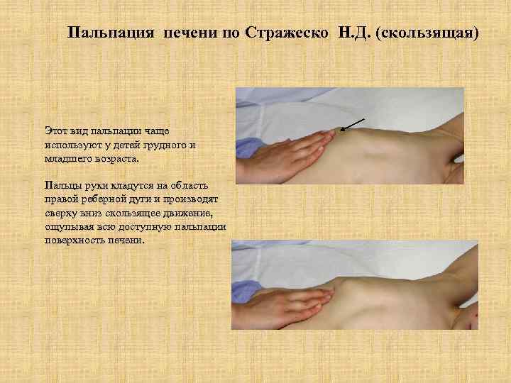 Пальпация печени по Стражеско Н. Д. (скользящая) Этот вид пальпации чаще используют у детей