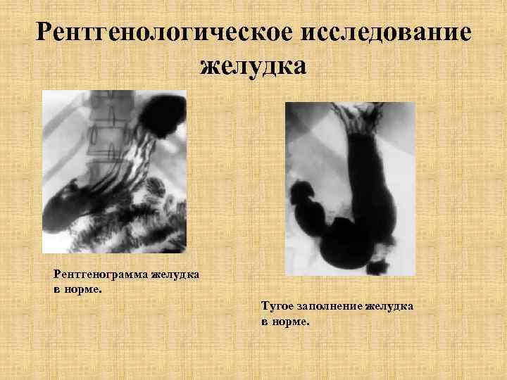 Рентгенологическое исследование желудка Рентгенограмма желудка в норме. Тугое заполнение желудка в норме. 