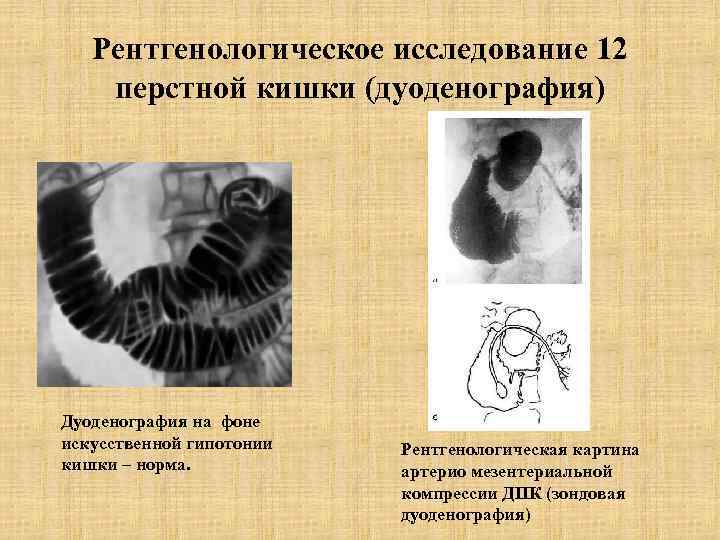 Рентгенологическое исследование 12 перстной кишки (дуоденография) Дуоденография на фоне искусственной гипотонии кишки – норма.