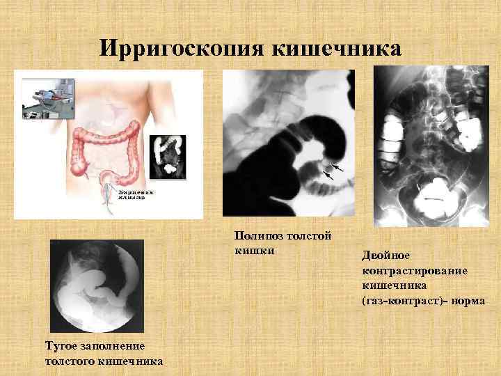 Ирригоскопия кишечника Полипоз толстой кишки Тугое заполнение толстого кишечника Двойное контрастирование кишечника (газ-контраст)- норма