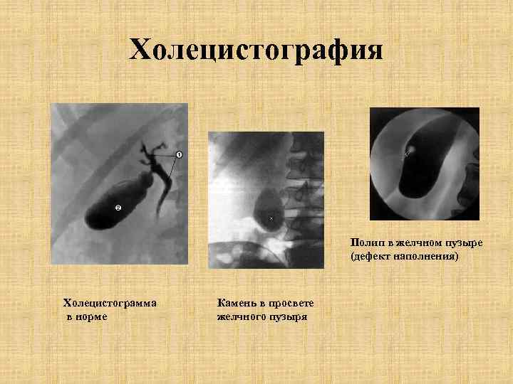 Холецистография Полип в желчном пузыре (дефект наполнения) Холецистограмма в норме Камень в просвете желчного