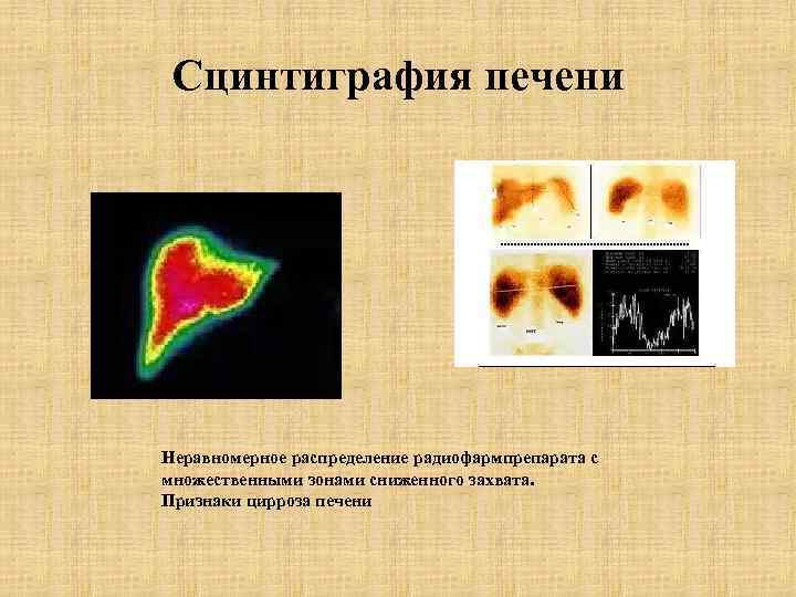 Сцинтиграфия печени Неравномерное распределение радиофармпрепарата с множественными зонами сниженного захвата. Признаки цирроза печени 