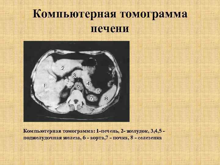 Компьютерная томограмма печени Компьютерная томограмма: 1 -печень, 2 - желудок, 3, 4, 5 поджелудочная