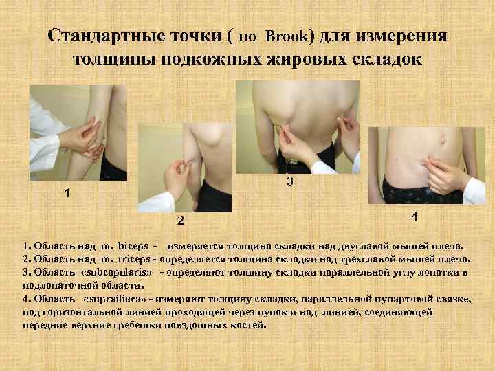   Стандартные точки ( по Brook) для измерения  толщины подкожных жировых складок