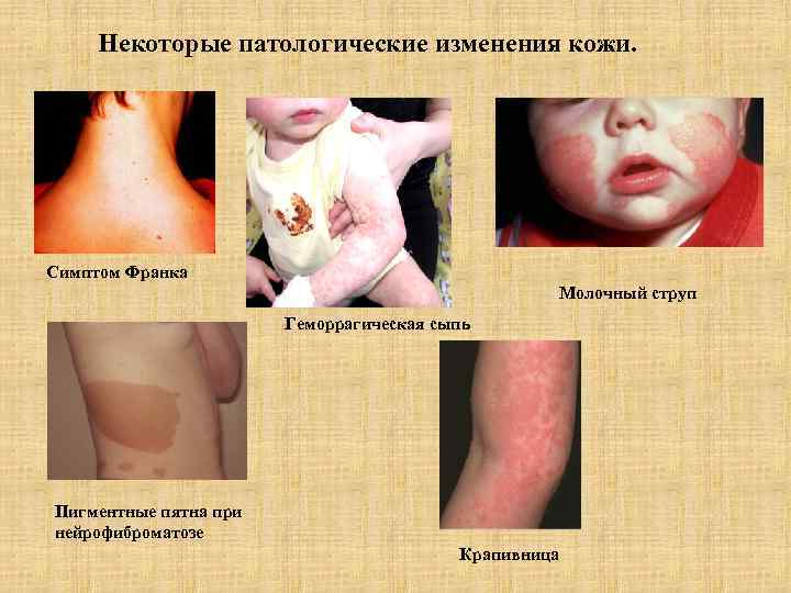  Некоторые патологические изменения кожи. Симптом Франка     Молочный струп 
