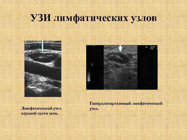 Протокол узи лимфатических узлов образец