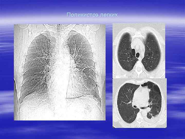 Поликистоз легких 