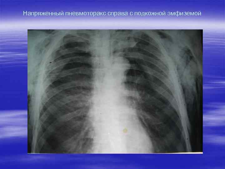 Пневмоторакс лучевая диагностика презентация