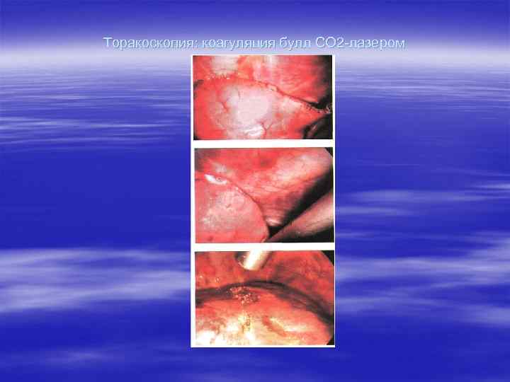 Торакоскопия: коагуляция булл СО 2 -лазером 