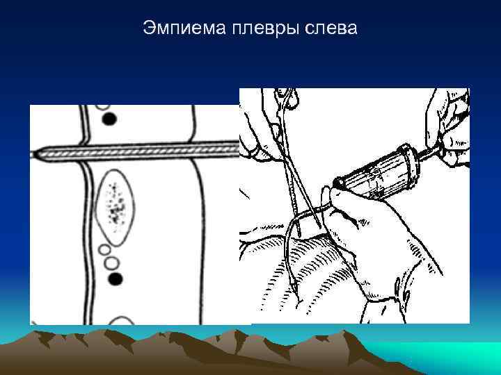 Эмпиема плевры слева 