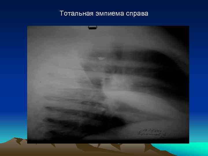 Тотальная эмпиема справа 