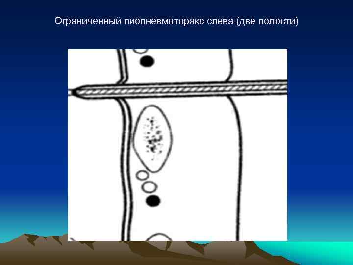 Ограниченный пиопневмоторакс слева (две полости) 