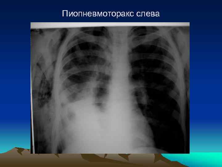 Пиопневмоторакс слева 