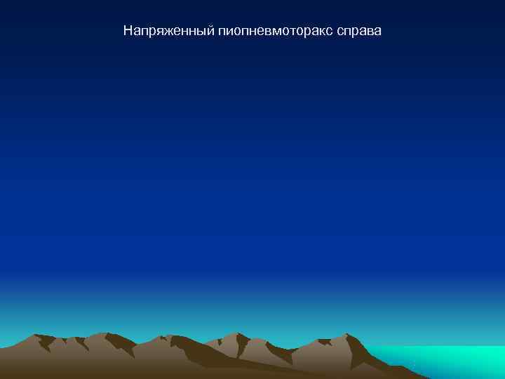 Напряженный пиопневмоторакс справа 