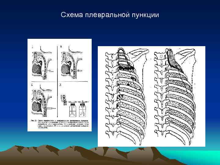 Схема плевральной пункции 