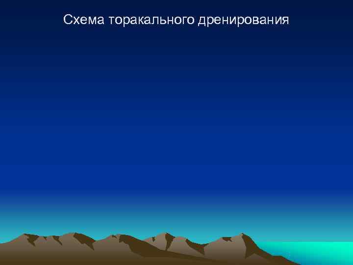 Схема торакального дренирования 