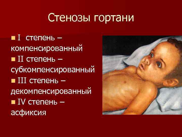    Стенозы гортани n I степень – компенсированный n II степень –