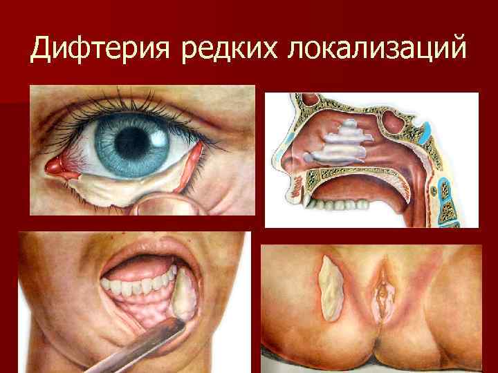 Дифтерия редких локализаций 